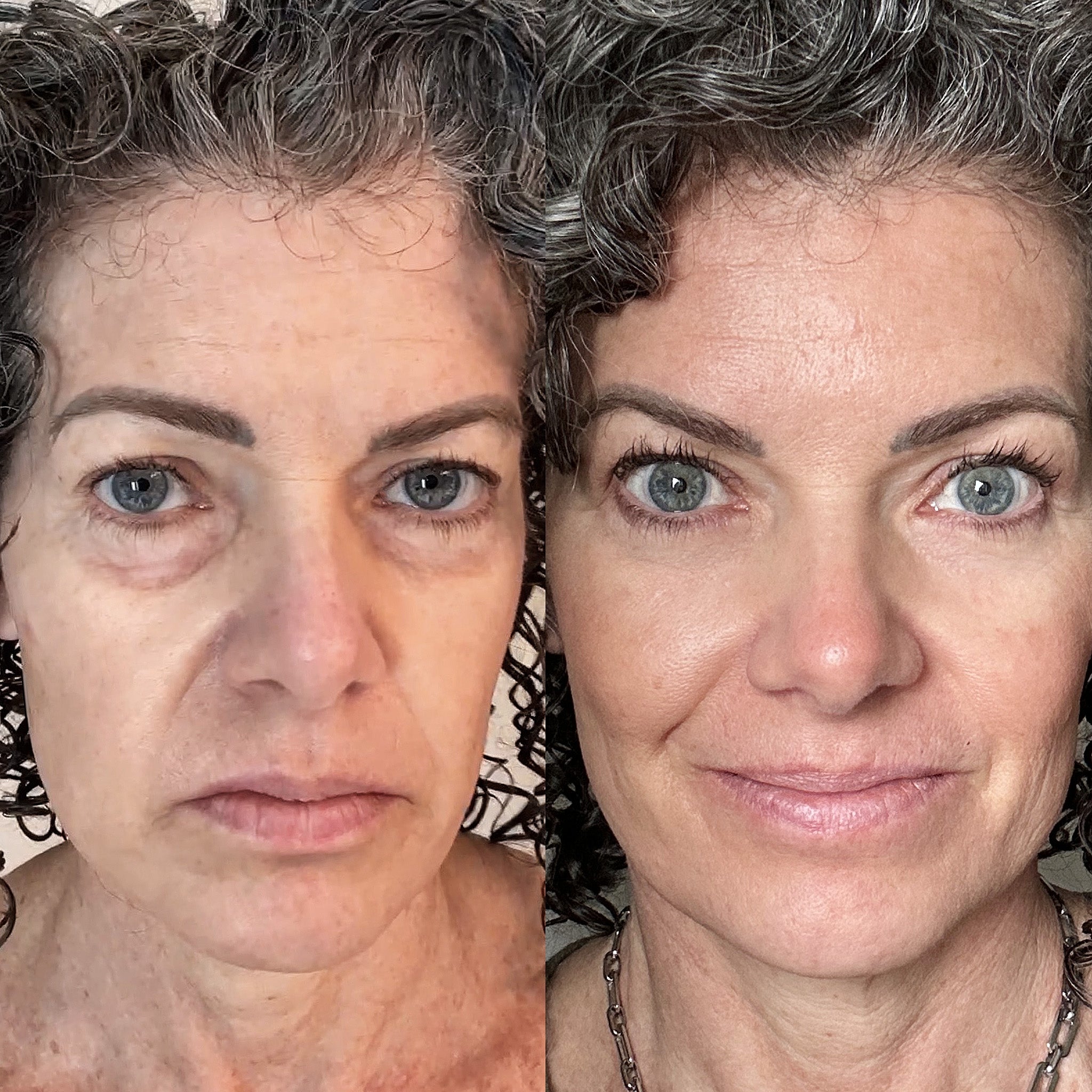 LumiEyes Red Light Therapy Testimonials