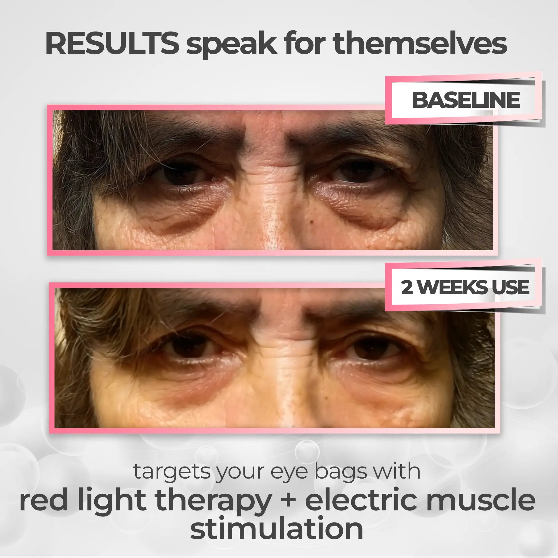 LumiEyes™ 2 - in - 1 Red Light Therapy + EMS To Erase Eye Bags - Luvée