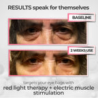 LumiEyes™ 2 - in - 1 Red Light Therapy + EMS To Erase Eye Bags - Luvée