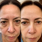 LumiEyes™ 2 - in - 1 Red Light Therapy + EMS To Erase Eye Bags - Luvée
