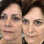 LumiEyes™ 2 - in - 1 Red Light Therapy + EMS To Erase Eye Bags - Luvée
